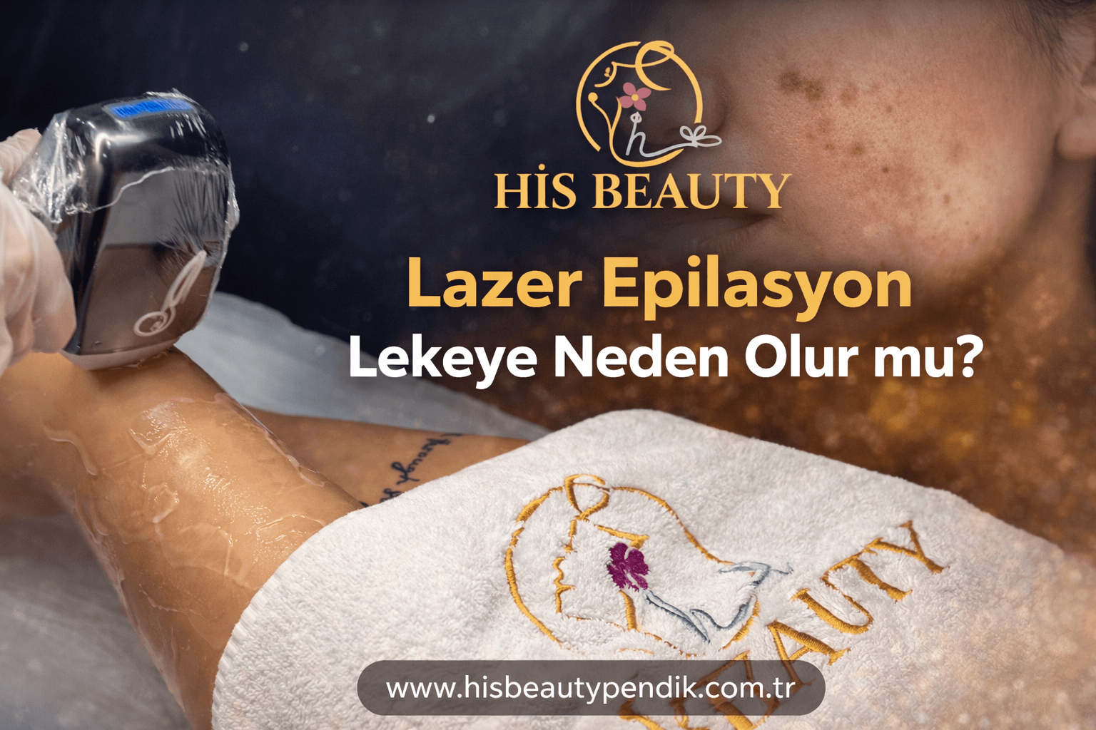 Lazer epilasyon uygulaması sırasında ciltte oluşabilecek leke riskini gösteren bilgilendirici görsel